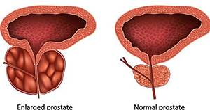 benign prostate hyperplasia