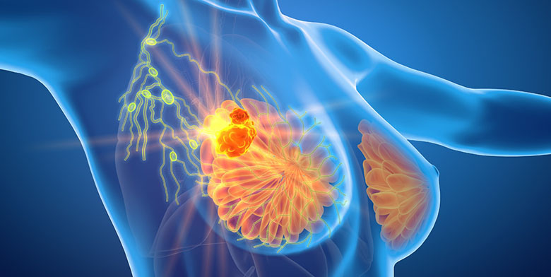 Doxycycline Antibiotic may Prevent Breast Cancer Relapse