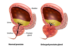 benign-prostate-hyperplasia