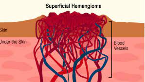 hemangioma