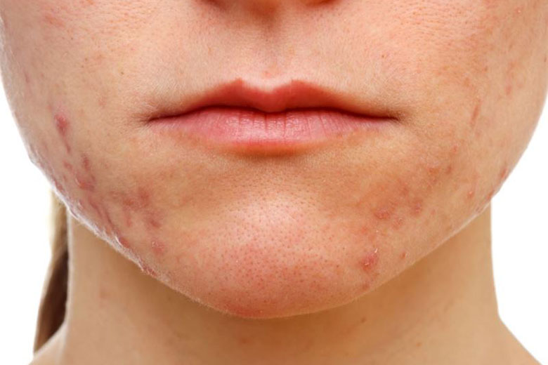 Home Remedies for Curing Acne